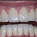 Full Mouth Restoration