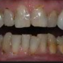 Full Mouth Restoration