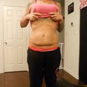 3 weeks(ish) pre-op, front view.