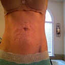 This is right before the tummy tuck.  I didn't need lip, but had a hernia and a lot of loose skin