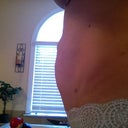 This is the hernia you can see pushing out.  It would slowly come out during the day and I had to push it back in. The doctor called it "reducible"