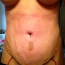 3 days post op full view from full tummy tuck. There are 2 drains, a vertical incision and the horizontal incision.