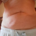Couldn't even see my belly botton.  You can see the fat pooch I was so worried wouldn't go away during procedure and my "twin pouch".    Oh my.  Maybe you can understand how I never thought I could be fixed!