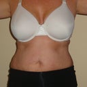 20 Days Post OP