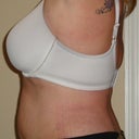 20 Day Post Op
