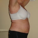 20 Day Post Op