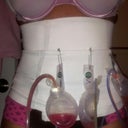 The garment, and yes I am still draining but the drainage is now slowing down.  6 days post op