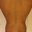 BEFORE Treatment: My whole back. You can see that the tiny cream/whitish patches grew into bigger patches over time.