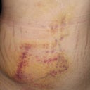 3 days post opp (worst of the brusing)