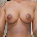 Breasts at 3 months, 1 day.