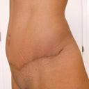 3 months, 1 day. Oblique view.