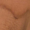 3 months, 1 day. This part of the scar has stretched out and become dark. It is the only place this has happened on my body.