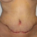 post op day 16 front