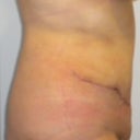 post op day 16 side