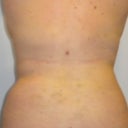 post op day 16 back