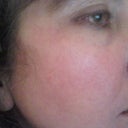 4 days post peel