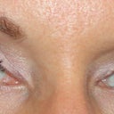 3 weeks post surgery. I can still see/feel scar tissue, but makeup hides it really well :)