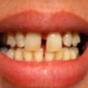 Beginning of Tray 3- without Invisalign