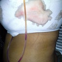 Got quite bloody- 1 day post op