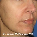 Melasma Treatment