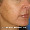 Melasma Treatment