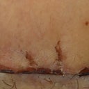04/19/13-2 weeks-front scar close up-scabbing