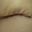 04/19/13-2 weeks-left side scar close up