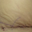 04/19/13-2 weeks-right side scar close up