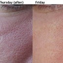 Fraxel II Progression