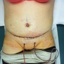 4 days PO Very swollen, very satisfied.