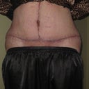 POD 12 Lower abdomen incision tape removed.  Looking good!
