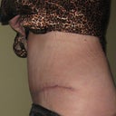 POD 12 Left side view.  Incision nice and low, even at hip.  Healing well.