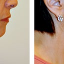 63 Year Old Female Treated For Sagging Neck Skin
