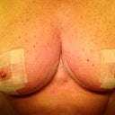 Just before leaving for 4 week post op. Strips still in place.