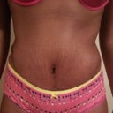 PO DAY 15 My seroma is located right above my belly button. My scar is healing nicely. If you look above the yellow bow u can see the lower part of my scar is already fading.