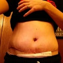 5 days after surgery.