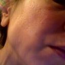 Can a scar located in the center of my cheek be excised?  Also a "what to do" question: A doctor scarred my face 10 years ago, went to another doctor who made it much less noticeable, went to yet another doctor recently and he made it much worse.  Do I go back to the doctor that helped me before or will he just throw me out of his office? I so wish I left well-enough alone! BTW it is really hard to see in this photo but the scar is depressed on the top half and raised on the bottom half. I'll try to post a better picture.