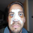Post-op+3. Still some bruising around the eyes, uneven nostrils, and blue stitching