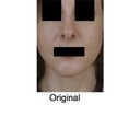 2012 nose before revision. Pic taken at doctor's office
