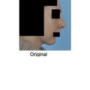 2012 nose before revision. Note hanging columella/alar retraction.