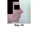 3 days after cast removal. Looks and feels very big and swollen but no more giant nostril peep show