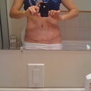 Scar at almost 5 weeks post op, swelling is gone.