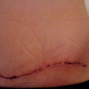 Tummy tuck side view 9 days post op