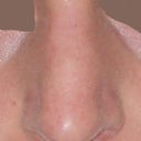 Front post-rhinoplasty