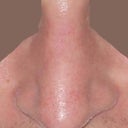 Front Smiling post rhinoplasty
