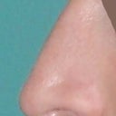 Left post rhinoplasty
