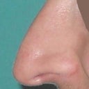 Left smiling post rhinoplasty
