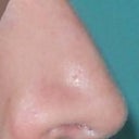 right post rhinoplasty