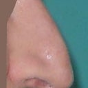 right smiling post rhinoplasty