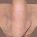 Top post rhinoplasty